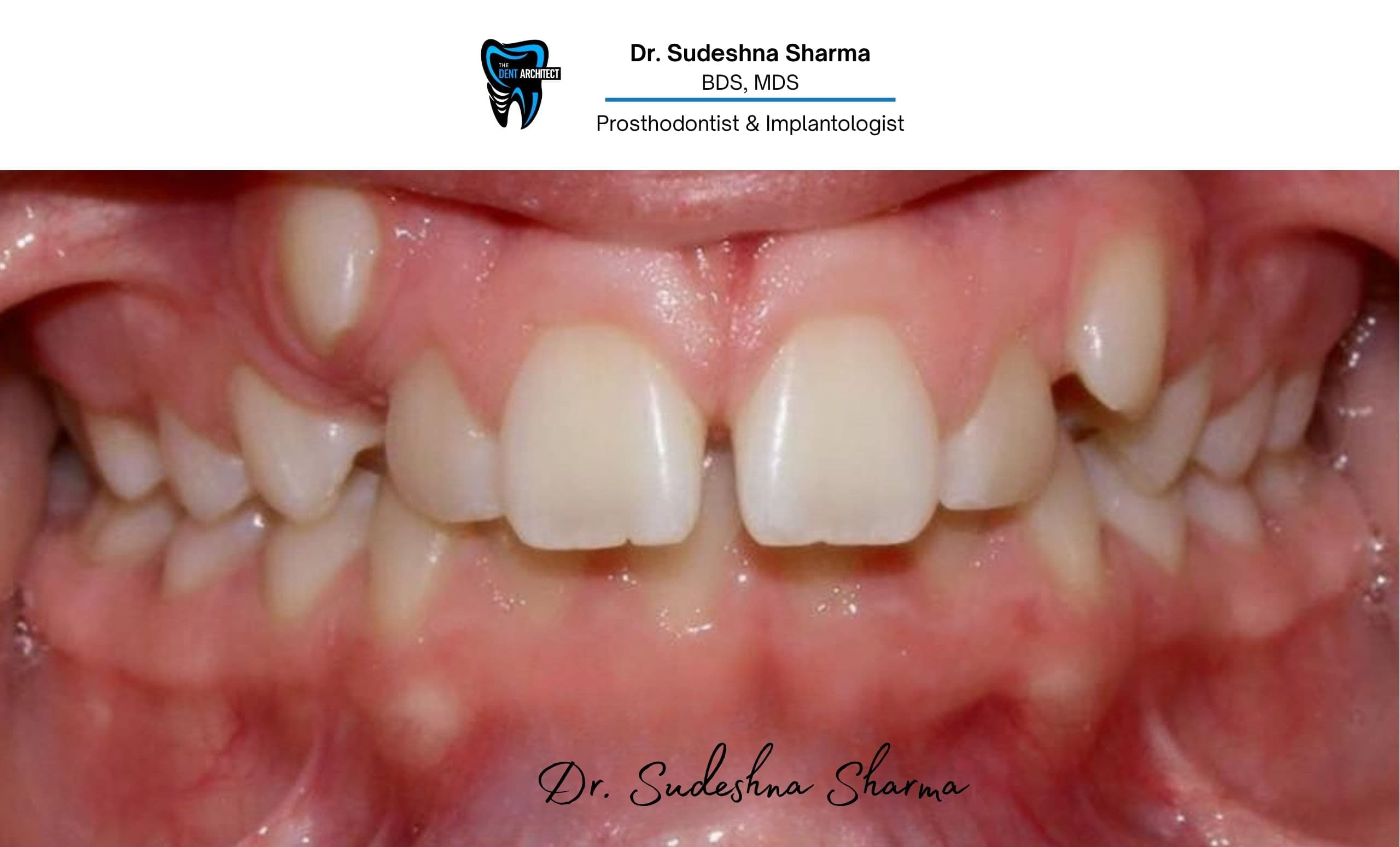 Before · missing molar
