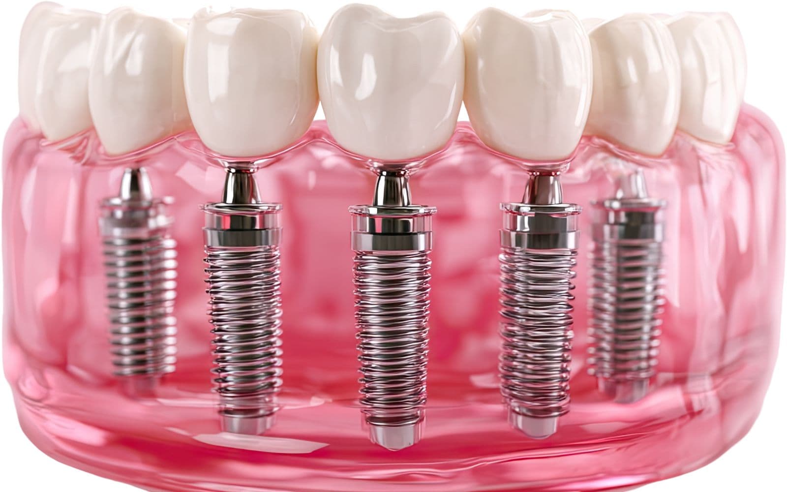 Full-mouth rehabilitation — clinical photo